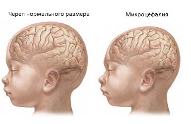 Синдром Эдвардса: короткая, но полная любви жизнь — Про Паллиатив